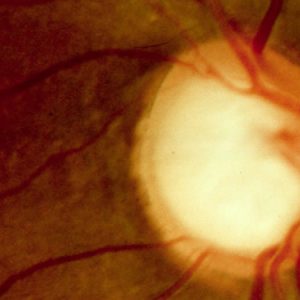 Glaucoma o que é, causas, sintomas e tratamento Glaucoma o que é, causas, sintomas e tratamento