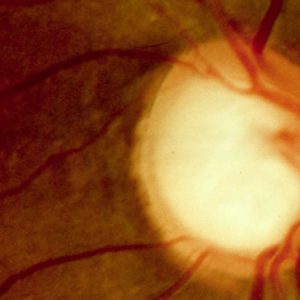 Glaucoma o que é, causas, sintomas e tratamento