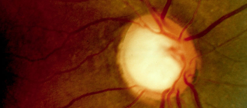 Glaucoma o que é, causas, sintomas e tratamento