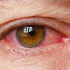 Alergia nos olhos diagnóstico e tratamentos