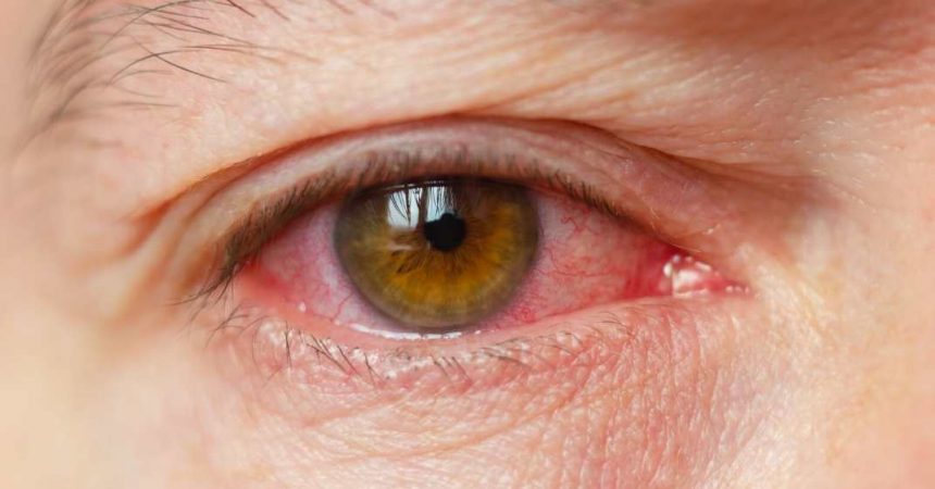 Alergia nos olhos diagnóstico e tratamentos