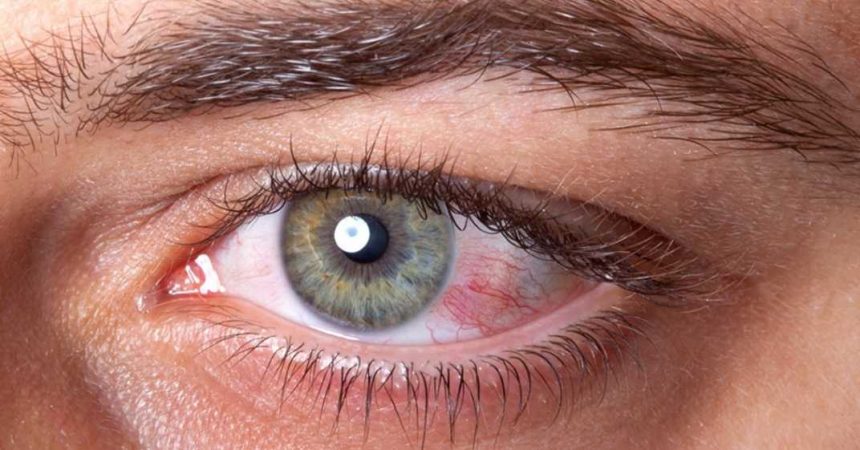 Olhos vermelhos causas e tratamentos