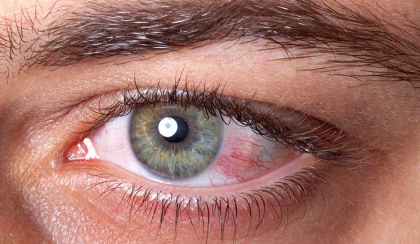 Olhos vermelhos causas e tratamentos