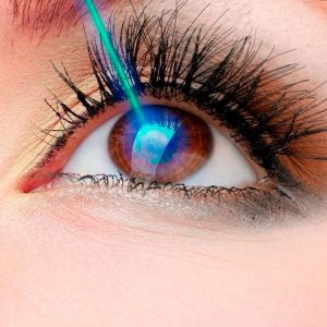 Cirurgia de miopia: O guia definitivo