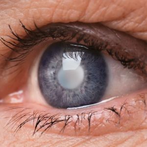 Cataratas nos olhos: Conheça os primeiros sinais de alarme Cataratas nos olhos: Conheça os primeiros sinais de alarme