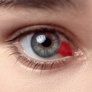 Derrames nos olhos evitável: um alerta sobre os riscos e medidas de prevenção