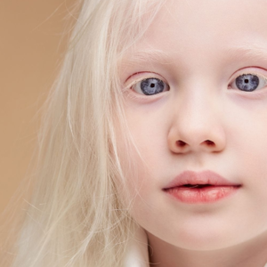 Albinismo ocular: o que é, causas e tratamento