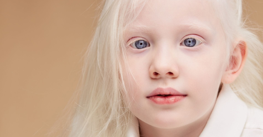 Albinismo ocular: o que é, causas e tratamento