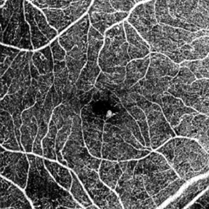 Angiografia ocular: o que é e como funciona