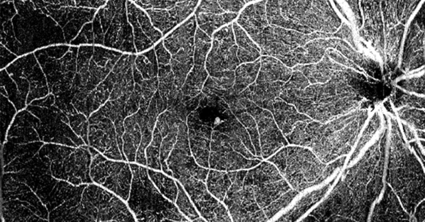 Angiografia ocular: o que é e como funciona