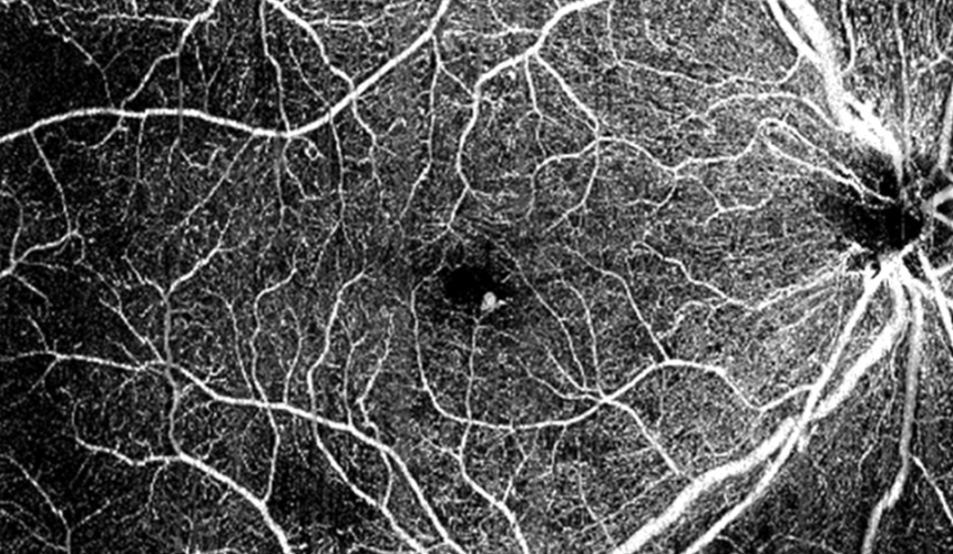 Angiografia ocular: o que é e como funciona