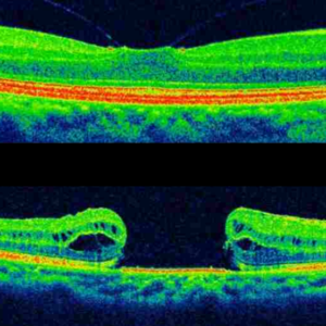 Buraco Macular: o que é, causas, sintomas e tratamento