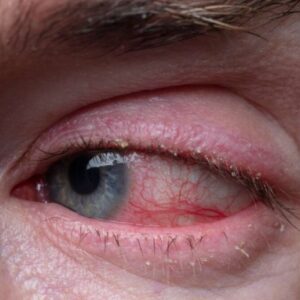 Blefarite: o que é, sintomas, causas tratamento, prevenção