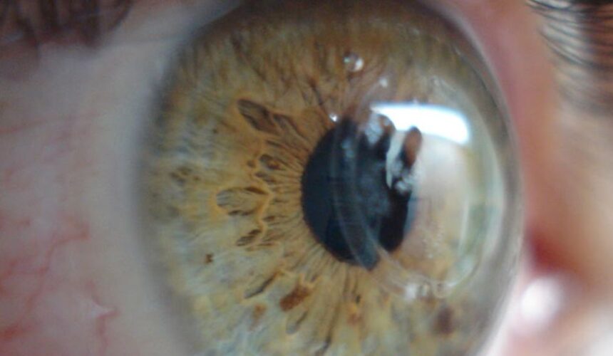 Anéis intraestromais: o que é e como funciona o implante Anéis intraestromais: o que é e como funciona o implante