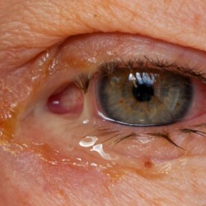 Conjuntivite: o que é, causas, sintomas e como tratar