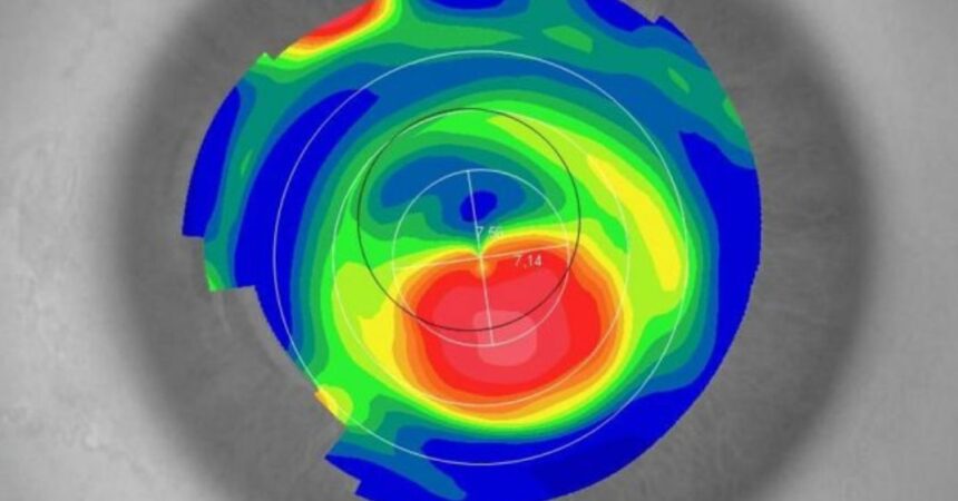 Aberrometria: o que é, como funciona, para que serve, e recomendações