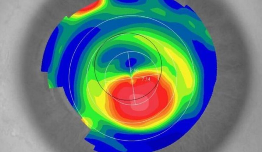 Aberrometria: o que é, como funciona, para que serve, e recomendações Aberrometria: o que é, como funciona, para que serve, e recomendações