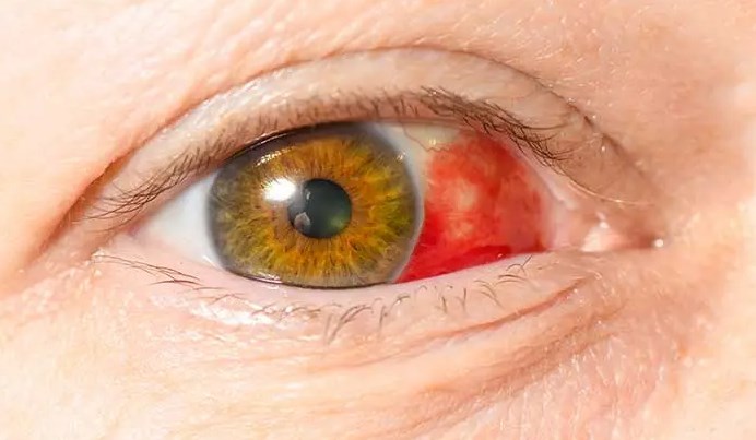 Hemorragia Subconjuntival