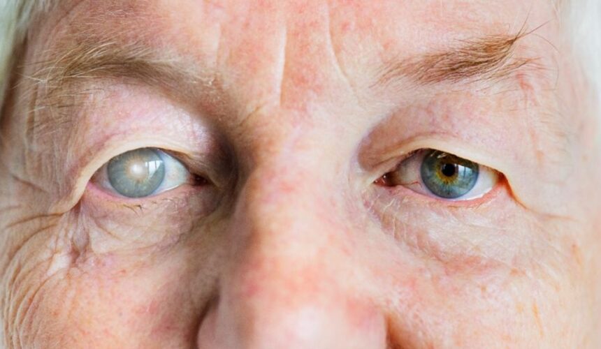 Catarata: o que é, causas da doença, tratamentos e sinais / sintomas Catarata: o que é, causas da doença, tratamentos e sinais / sintomas