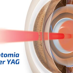 Capsulotomia por laser YAG: o que é? Capsulotomia por laser YAG: o que é?